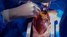 World's First HIV+ to HIV+ Heart Transplant Performed