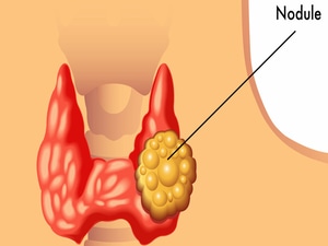 Nonsurgical Option for More Large Thyroid Nodule Patients?