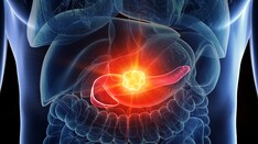 Microsimulation Model Identifies 4-Year Window for Pancreatic Cancer Screening