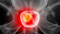 mi a gyakorlat ha a prostatitis