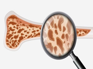 New Guidelines Address Osteoporosis Treatment Postmenopause