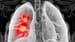 New Approach in Advanced NSCLC: Adding MET Inhibitor Savolitinib