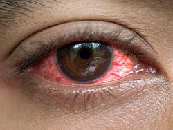 5 Myths About Dry Eye Disease
