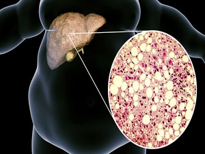 First Drug for Fatty Liver Disease Advances