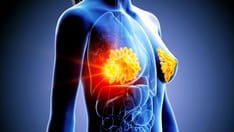 Long-Term Survival Benefit With Olaparib (Lynparza) in Metastatic Breast Cancer?