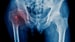 High Vitamin B6, B12 May Increase Hip Fracture Risk