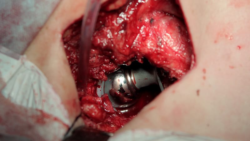 Updated Perioperative Guidance Says When to Hold Antirheumatics