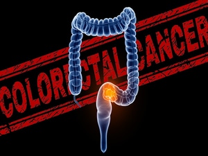 Timing of Colorectal Cancer Screening Disputed