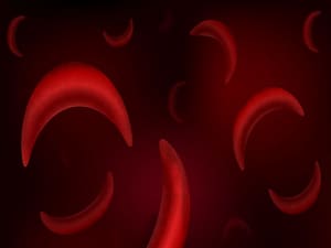 Novel Drug Could Be 'Disease Modifying' in Sickle Cell Disease