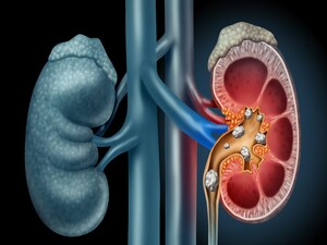 Diet vs Medications for Recurrent Kidney Stones