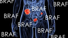 Gene Instability Predicts Relapse in Early BRAF Mutated CRC