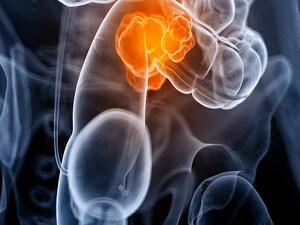 Skipping Surgery in Rectal Cancer: Better or Worse?
