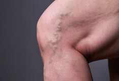 Sclerotherapy Treatment Management Surgical Therapy Preoperative Details Intraoperative Details