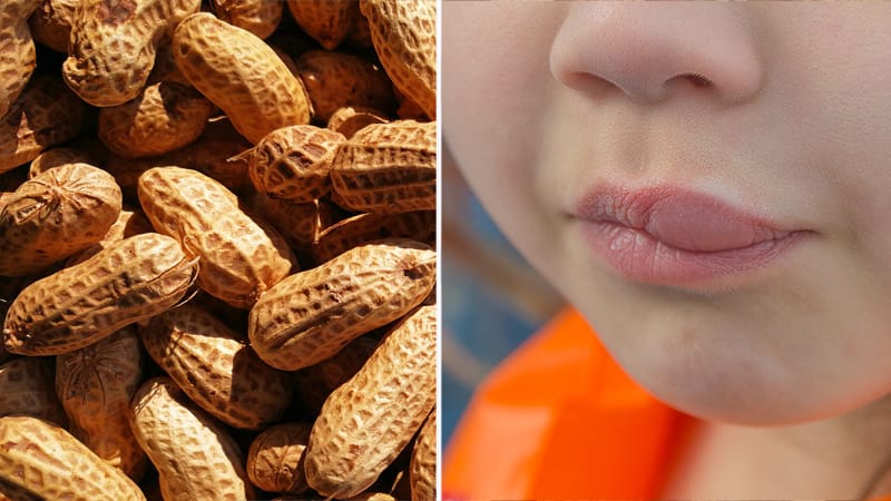 FDA OKs Palforzia, First Drug for Peanut Allergy in Children