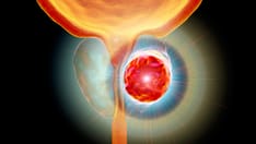 PSA and Prostate Cancer: Between Guidelines and Practice