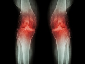 Real Acupuncture Beat Sham for Osteoarthritis Knee Pain
