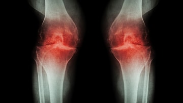 osteoarthritis medscape treatment