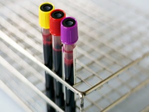 Simple Blood Test Highly Accurate in Detecting Alzheimer's Biomarker