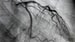 COACT at 1 Year: Later Angiography Okay in Non-STEMI Cardiac Arrest