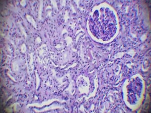 Novel Antibody Improves Renal Outcomes in Lupus Nephritis