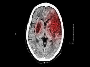 Is There a Need for tPA Before Thrombectomy in Stroke?