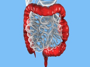 Patients With IBD Prone to Irritable Bowel Syndrome