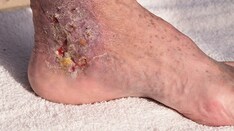Cellulitis Care Costly From Misdiagnosis, Needless Hospitalizations