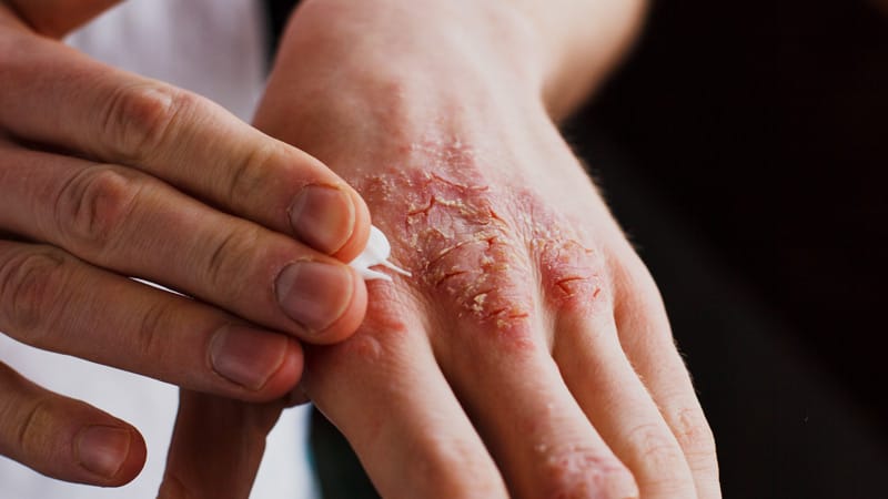 EMA Panel Backs Crisaborole (Staquis) for Atopic Dermatitis
