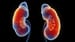Contrast-Induced Kidney Injury Risk Low in CKD