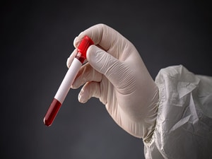 Blood Test Detects Colon Cancer in Single-Center Study