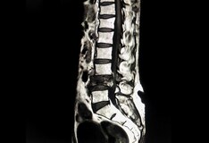 Prolia Xgeva Denosumab Dosing Indications Interactions Adverse Effects And More