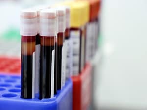 Study Reveals Disparities in CRC Biomarker Testing Trends