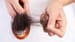 Hair Loss an Unexpected COVID Misery for Many
