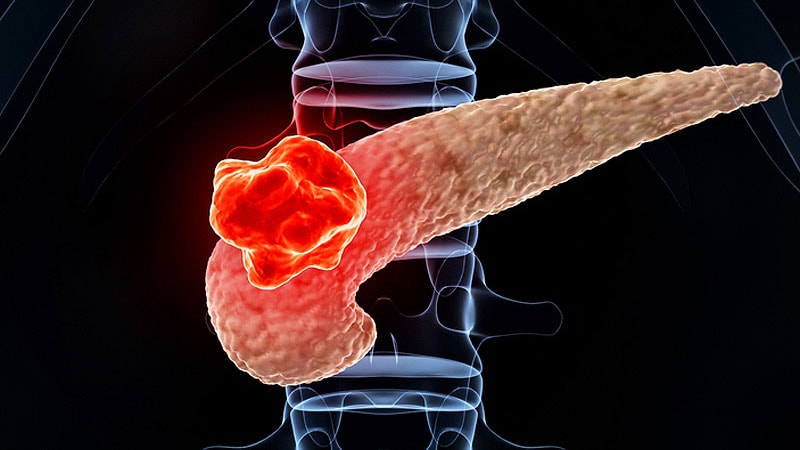 Noncolorectal Gastrointestinal Cancer | Medscape