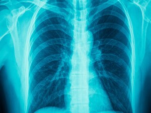 Bronchoscopic Interventions Promising for Patients With COPDBronchoscopic Interventions Promising for Patients With COPD