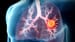 Metformin Disappoints in Two Phase 2 Lung Cancer Trials