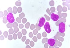 Tumor Lysis Syndrome Practice Essentials Pathophysiology Etiology
