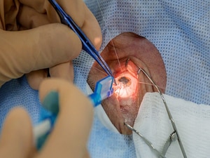 Combined Glaucoma + Cataract Surgery as Effective as Separate