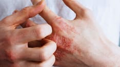 Fast Five Quiz: Dermatitis