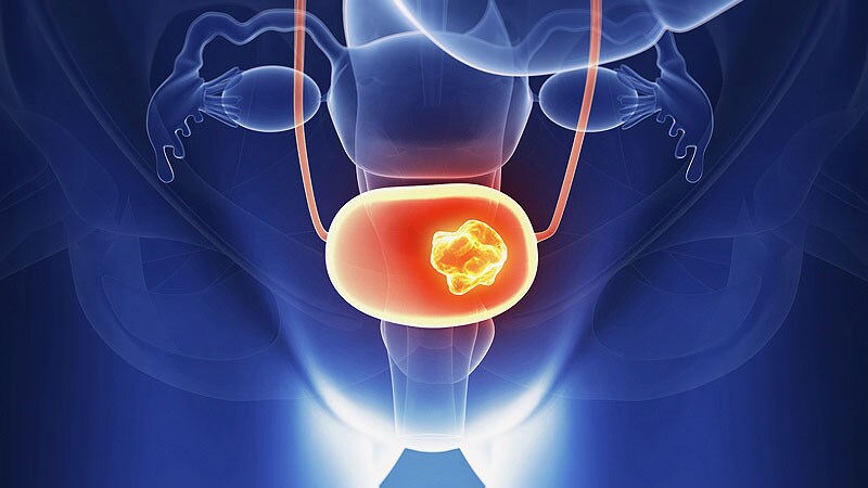 Bladder Cancer Medscape