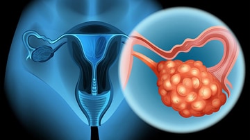 ovarian cancer medscape