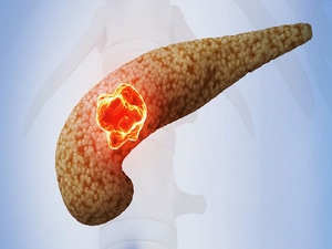 New Standard for Borderline Resectable Pancreatic Cancer