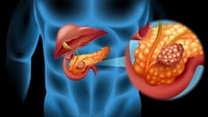 High Cost of Pancreatic Enzymes a Barrier for Patients With Cancer