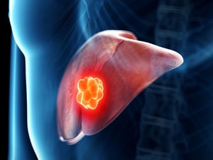 Dual Immunotherapy Promising New Option for Liver Cancer