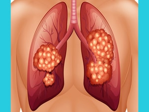 Sugemalimab Offers Another Option in Unresectable NSCLC