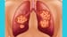 Amivantamab Shows Promise in Challenging EGFR-Mutated NSCLC