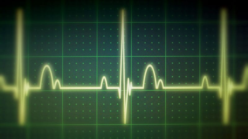 Some Patients With Type 2 Diabetes Have Major ECG Abnormalities