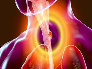 Alarming Increase in Esophageal Cancer in Middle-Aged Adults