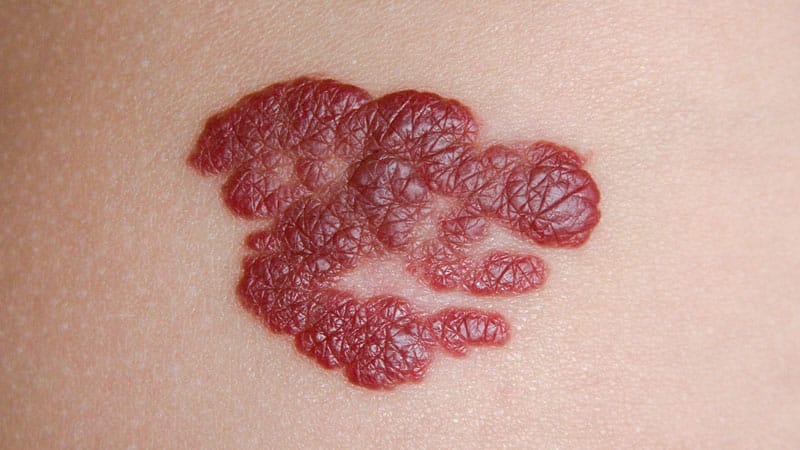Hepatic Hemangiomas Treatment & Management: Medical Care, Surgical