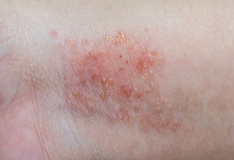 Dermatitis exfoliativa jelentése magyarul » DictZone Orvosi-Magy…